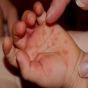 Uşaqlarda qorxulu virus: Müalicəsi yoxdur - Həkim