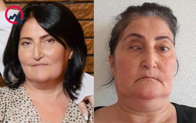 Bu klinika təzminat ödəyəcək - Burun düzəldəndə gözü zədələyib – FOTO
